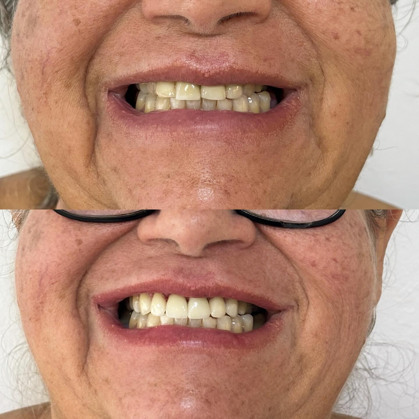 Prótese e Implante — antes e depois